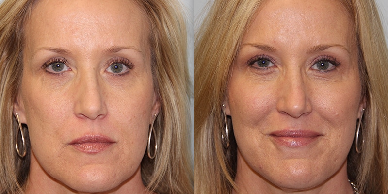 1764028512_Injectable-Treatment-Steven-Daines-MD-Appearance-Center-Newport-Beach-Orange-County-Plastic-Surgery.11.1